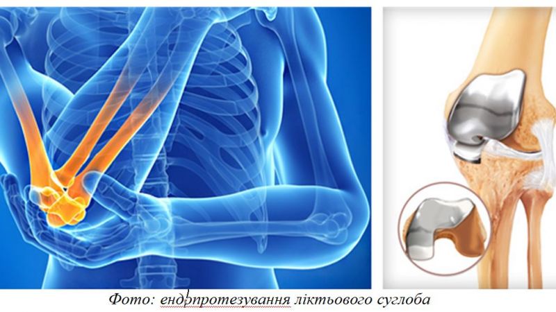 Ендопротезування суглобів у Києві: експертний огляд Омега-Київ